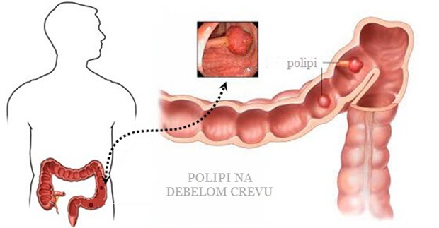 polipi_na_debelom_crevu_simptomi