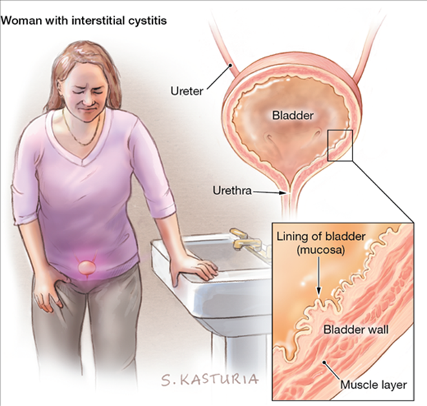 cystitis