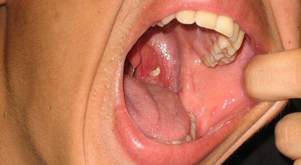 tonsillolith_in_mouth