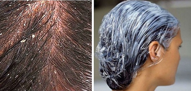 How-to-Prevent-Dandruff-e1365255739989