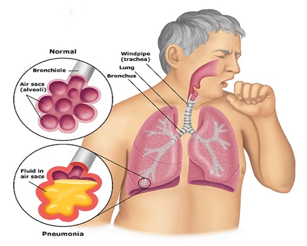 pneumonia