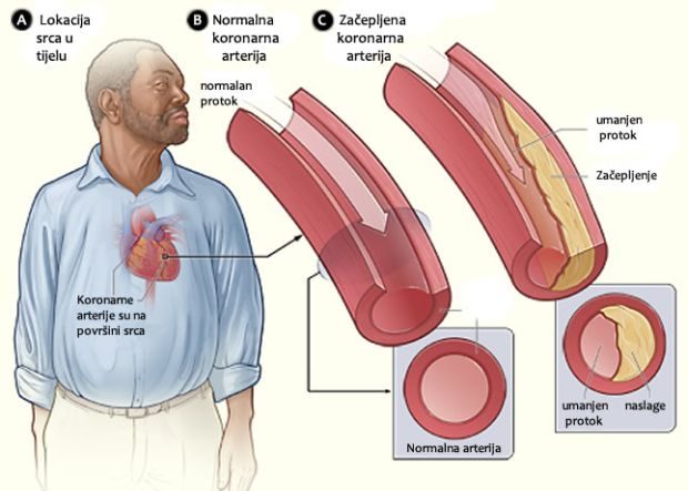 koronarne-arterije